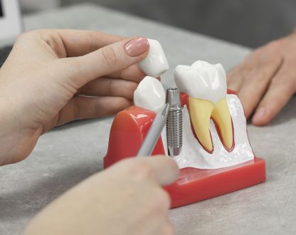 Understanding the Dental Implant Healing Stages: A Complete Guide